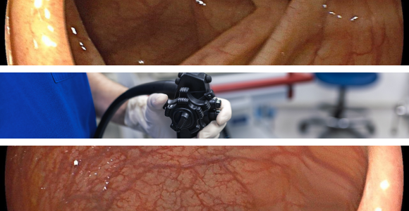大腸内視鏡検査