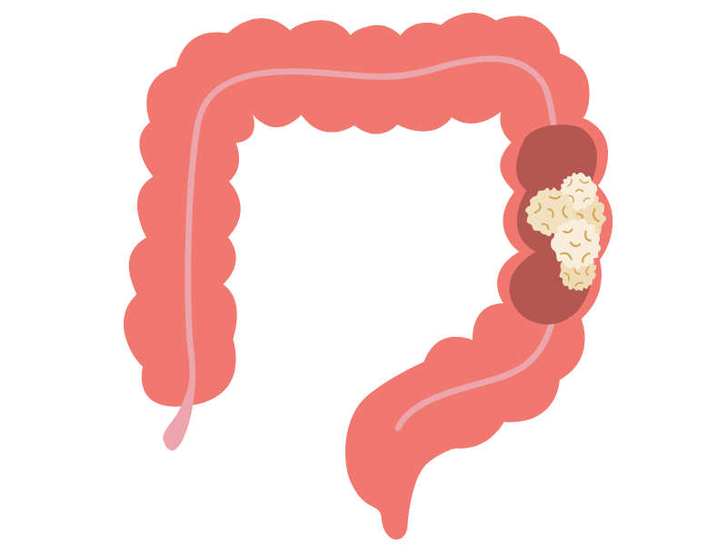 大腸がん