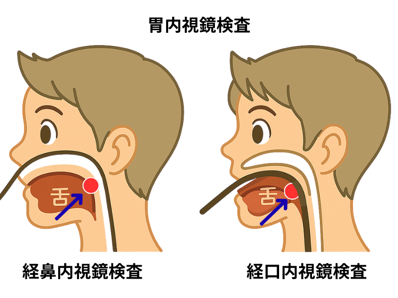 経鼻内視鏡と経口内視鏡の比較